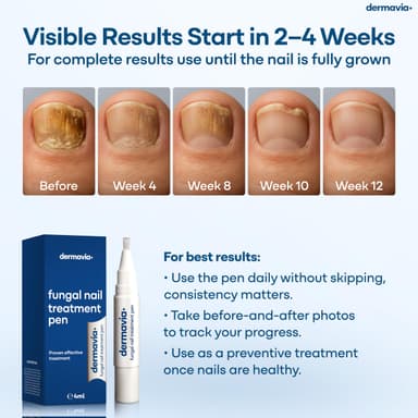 Fungal Nail Treatment – Nail Fungus Treatment for Toenail and Fingernails - 4ML Pen - Suitable for Diabetics - Clinically Proven Treatment view 3